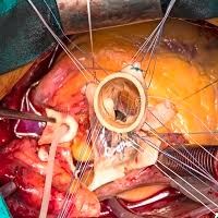 Disponibile in Italia una nuova valvola aortica transcatetere con tecnologia che ne aumenta la durata