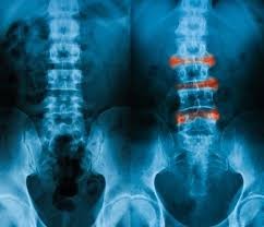 Congresso EULAR: guselkumab unico inibitore di IL-23 che inibisce la progressione del danno articolare in artrite psoriasica