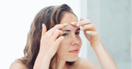 La natura ti aiuta nel caso di acne