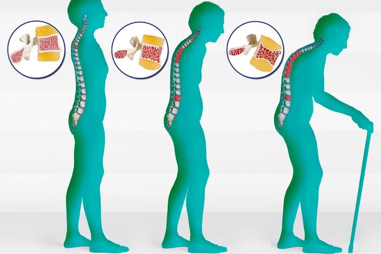 OSTEOPOROSI: importante monitorare l’altezza